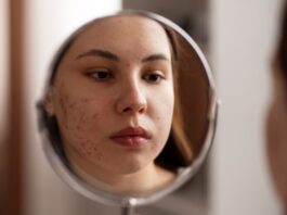 Acne se torna cada vez mais comum entre mulheres adultas