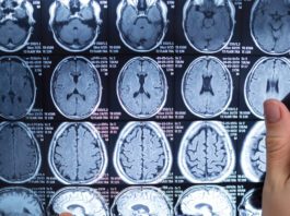 Neurocirurgião esclarece dúvidas sobre tumor cerebral