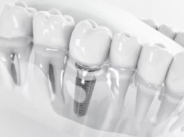 Implante zigomático traz nova alternativa na implantodontia