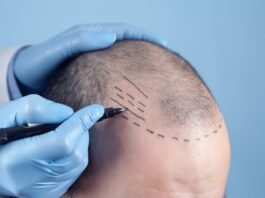 Tecnologia visa mais naturalidade em transplante capilares