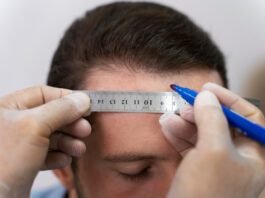 Queda capilar: médico explica quando considerar transplante