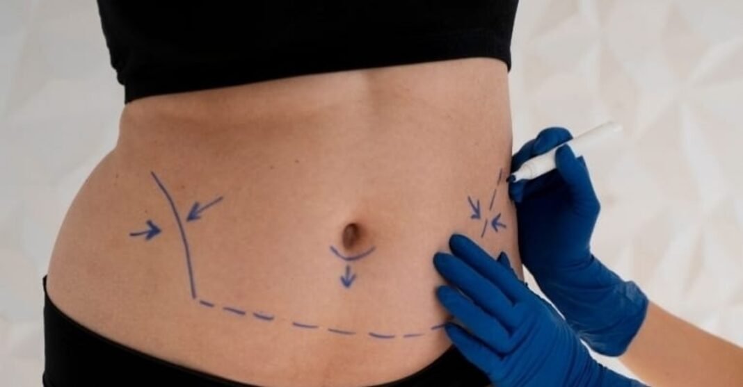 Mini ou abdominoplastia: especialista aponta melhor escolha Mini ou abdominoplastia: especialista aponta melhor escolha