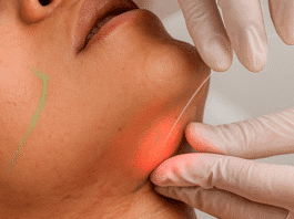 Laser subdérmico surge como alternativa à lipoaspiração