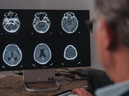 Setembro é o mês de conscientização do aneurisma cerebral
