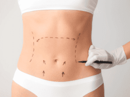 Avanços técnicos ajudam a reduzir cicatrizes cirúrgicas