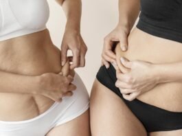 Lipoaspiração exige cuidados médicos rigorosos, alerta especialista