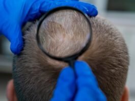 Tricologia ganha espaço no cuidado com a queda capilar