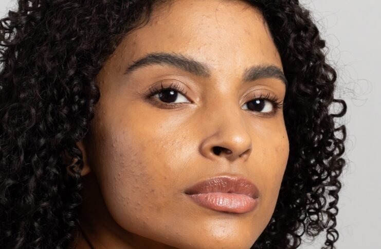 Mês de Conscientização da Acne incentiva cuidados especiais