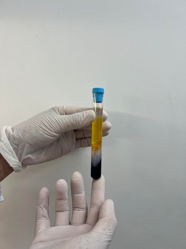 CFM regulamenta PRP em condições osteomusculares CFM regulamenta PRP em condições osteomusculares